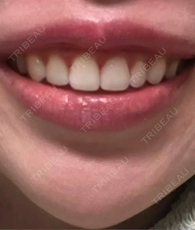 ボトックス（ガミースマイル） 椿クリニック 心斎橋院 DAY 18 メイン用