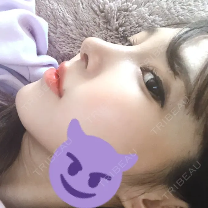 隆鼻術 / 鼻尖形成（切開） / 鼻中隔延長（切開） / 軟骨移植 / その他（鼻） FROM B整形外科 (旧バウム整形外科) DAY 23 メイン用