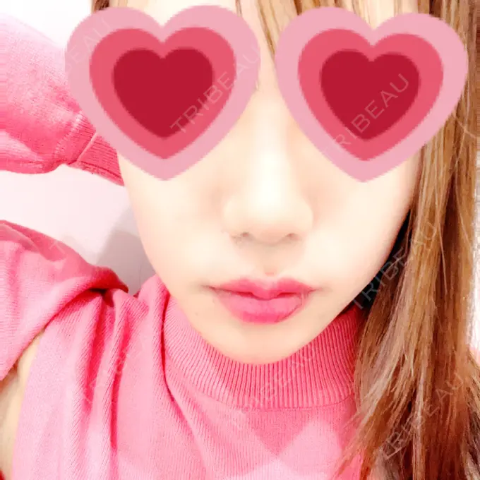 ヒアルロン酸注入（鼻） HAAB BEAUTY CLINIC 横浜院 AFTER メイン用