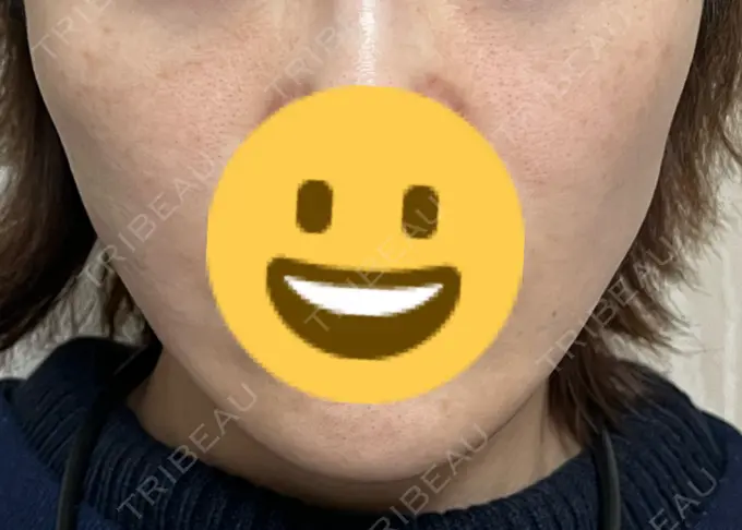 糸リフト 新宿美容外科クリニック 横浜院 AFTER メイン用