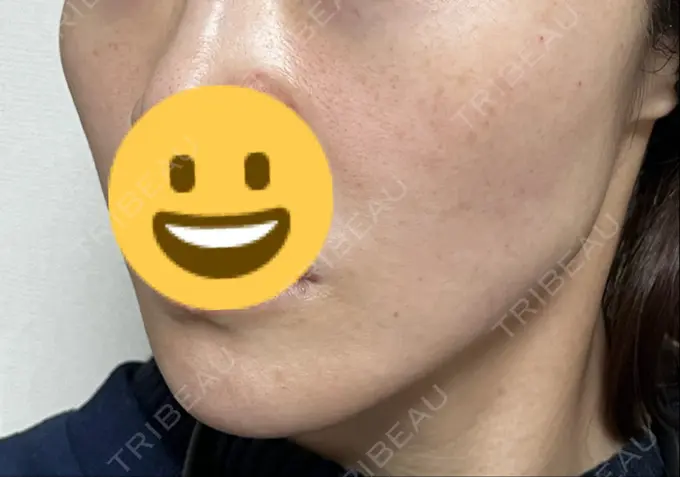 糸リフト 新宿美容外科クリニック 横浜院 DAY 0 メイン用