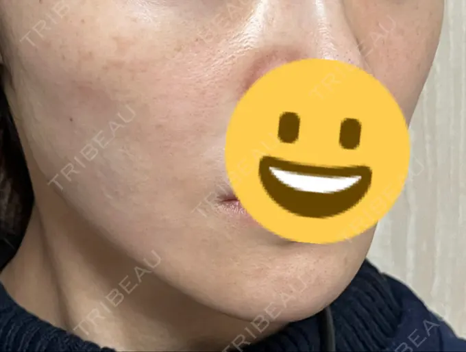 糸リフト 新宿美容外科クリニック 横浜院 DAY 0 メイン用