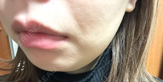 脂肪溶解注射（顔） 表参道ウィズ・クリニック DAY 1 メイン用