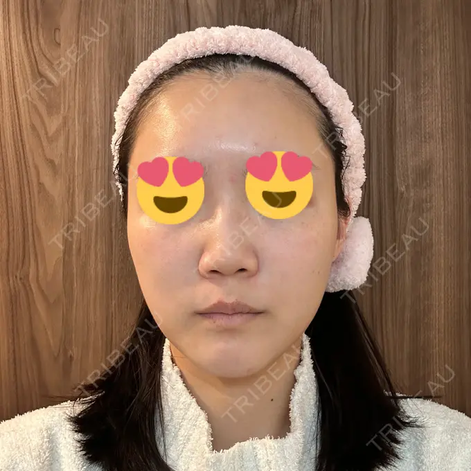 LED治療 id美容クリニック 銀座院 DAY 8 メイン用