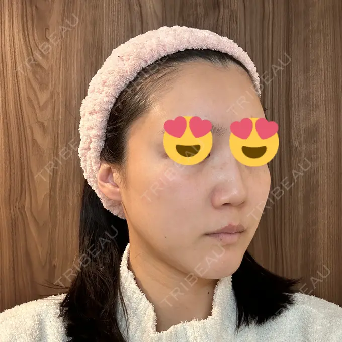 LED治療 id美容クリニック 銀座院 DAY 8 メイン用