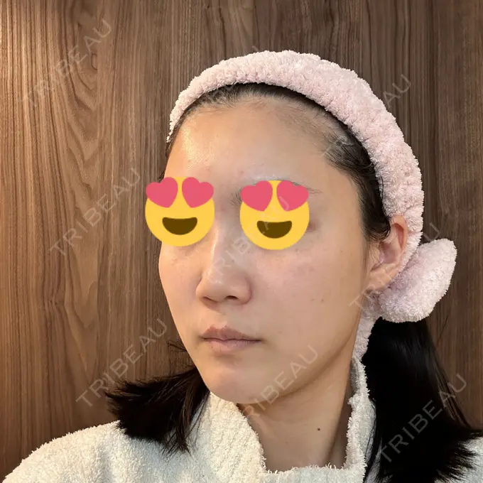 LED治療 id美容クリニック 銀座院 DAY 8 メイン用