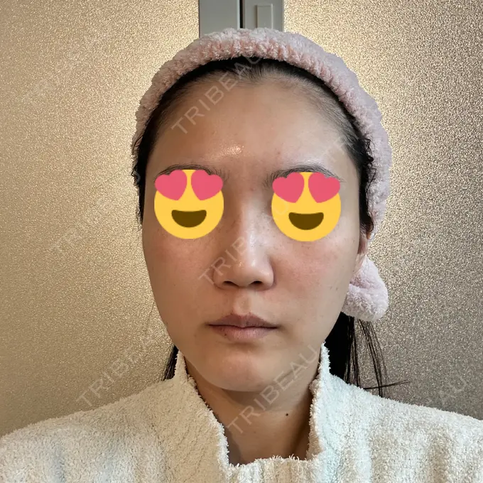 LED治療 id美容クリニック 銀座院 DAY 9 メイン用