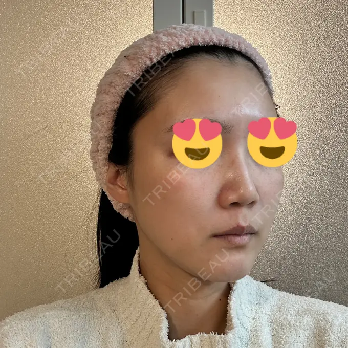 LED治療 id美容クリニック 銀座院 DAY 9 メイン用