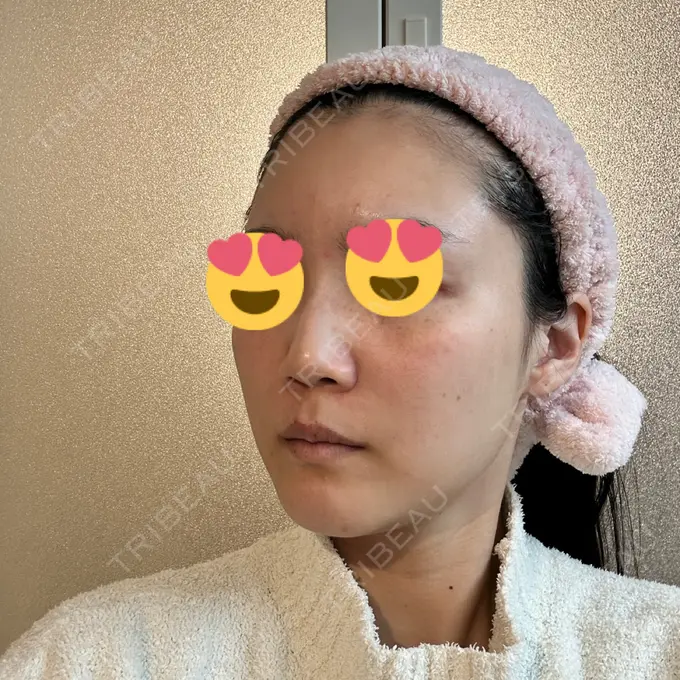 LED治療 id美容クリニック 銀座院 DAY 9 メイン用