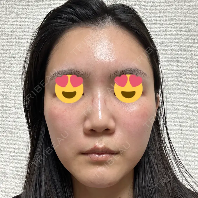 LED治療 id美容クリニック 銀座院 AFTER メイン用