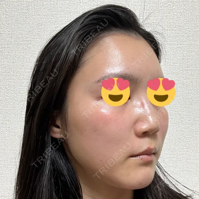 LED治療 id美容クリニック 銀座院 DAY 10 メイン用