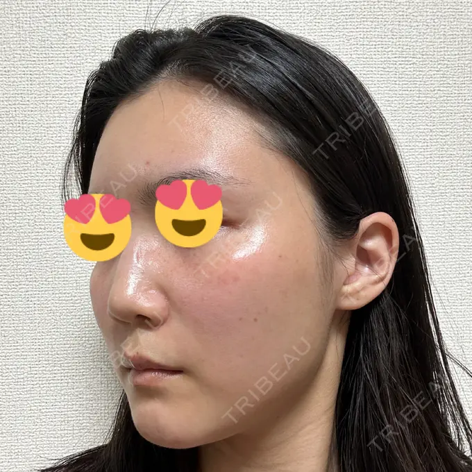 LED治療 id美容クリニック 銀座院 DAY 10 メイン用