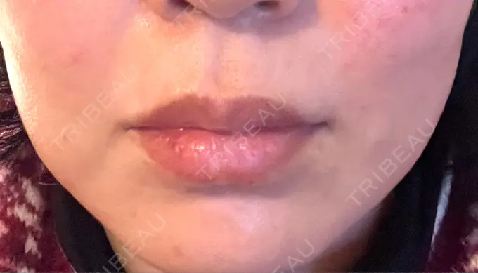 肌ヒアルロン酸注入（たるみ・シワ改善） / シワ取りボトックス TCB東京中央美容外科 福岡博多院 DAY 2 メイン用