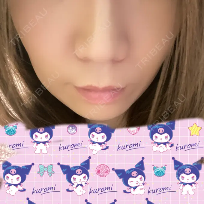 ボトックス（人中） veary clinic DAY 7 メイン用