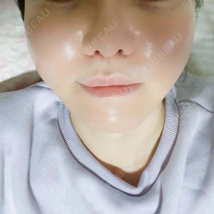 インディバ（顔） WOM SALON【術後ケア取扱いサロン】 DAY 40 メイン用