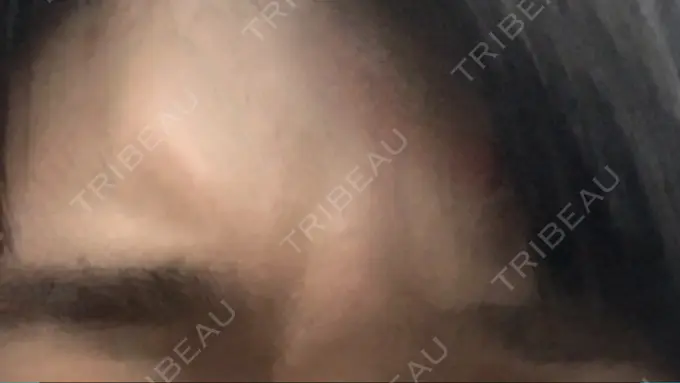 ボトックス（あご） / ボトックス（眉間） 湘南美容クリニック 京都院 DAY 1 メイン用