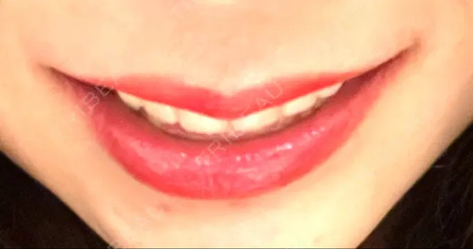 ガミースマイル手術 / 矯正（ワイヤー） / セラミック / その他（審美歯科/矯正歯科） 東京銀座A CLINIC デンタル AFTER メイン用