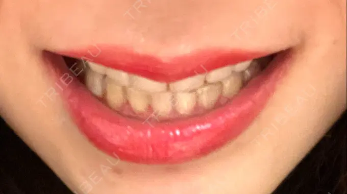 ガミースマイル手術 / 矯正（ワイヤー） / セラミック / その他（審美歯科/矯正歯科） 東京銀座A CLINIC デンタル DAY 463 メイン用