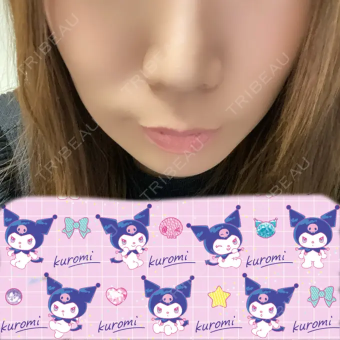 ボトックス（人中） veary clinic DAY 8 メイン用