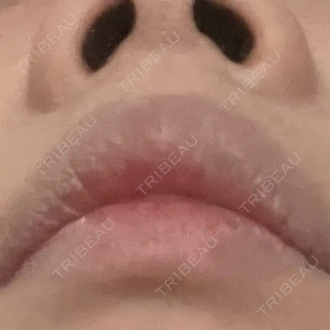 鼻中隔延長（非切開） / ボトックス（エラ・小顔） TCB東京中央美容外科 町田院 DAY 1 メイン用