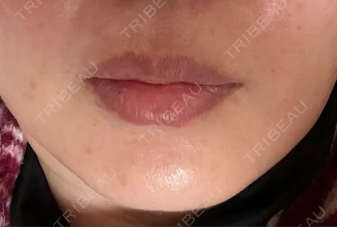 肌ヒアルロン酸注入（たるみ・シワ改善） / シワ取りボトックス TCB東京中央美容外科 福岡博多院 DAY 3 メイン用