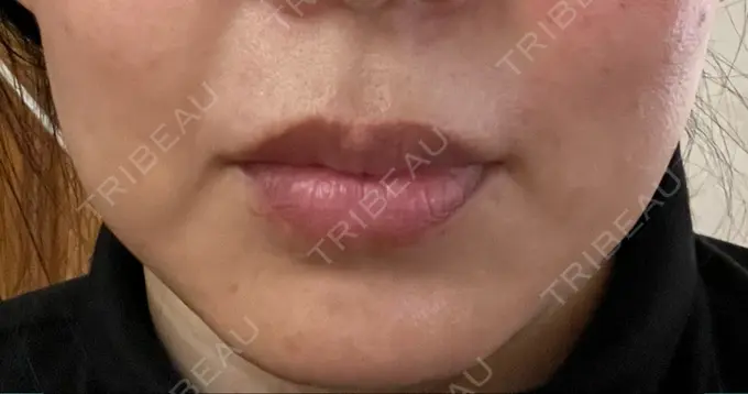 肌ヒアルロン酸注入（たるみ・シワ改善） / シワ取りボトックス TCB東京中央美容外科 福岡博多院 DAY 4 メイン用