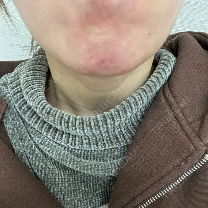 ボトックス（あご） TCB東京中央美容外科 高田馬場院 DAY 0 メイン用