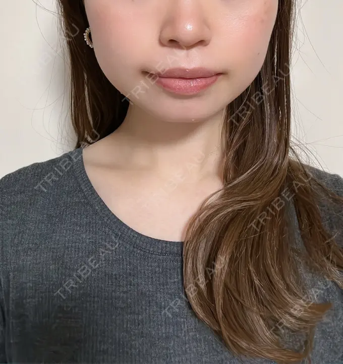 ボトックス（エラ・小顔） TCB東京中央美容外科 立川院 DAY 0 メイン用