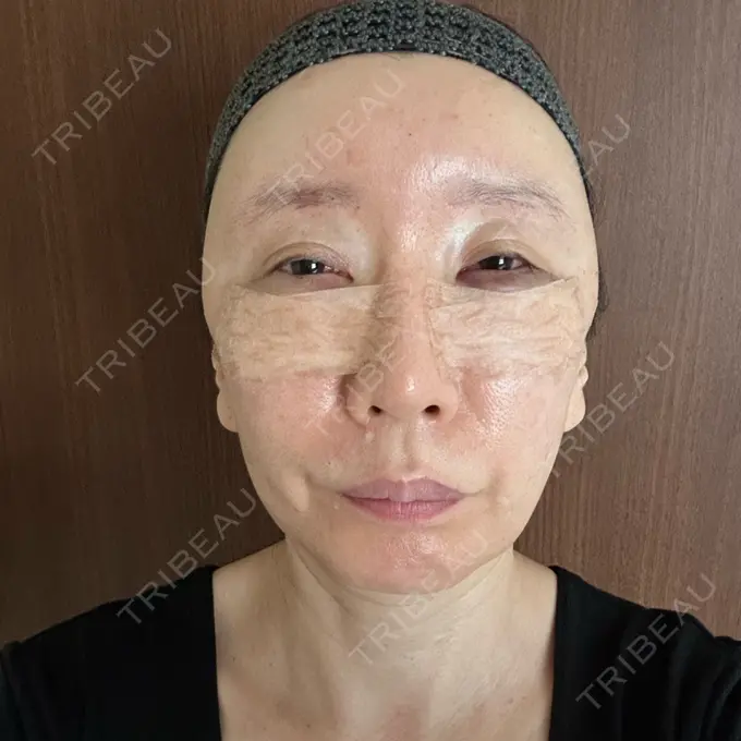 クマ治療 / 下まぶたたるみ取り / 脂肪注入（額） / 脂肪注入（目の下） / 脂肪注入（輪郭） エースクリニック 名古屋院 DAY 1 メイン用