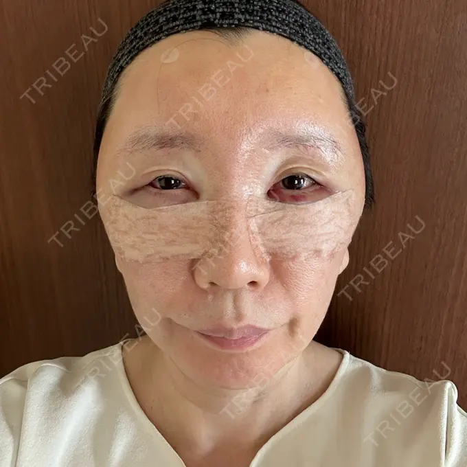 クマ治療 / 下まぶたたるみ取り / 脂肪注入（額） / 脂肪注入（目の下） / 脂肪注入（輪郭） エースクリニック 名古屋院 DAY 3 メイン用