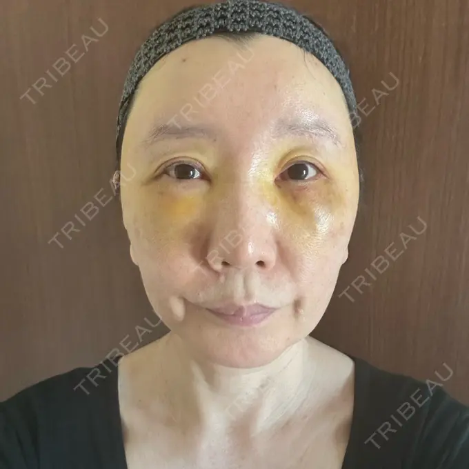 クマ治療 / 下まぶたたるみ取り / 脂肪注入（額） / 脂肪注入（目の下） / 脂肪注入（輪郭） エースクリニック 名古屋院 DAY 7 メイン用