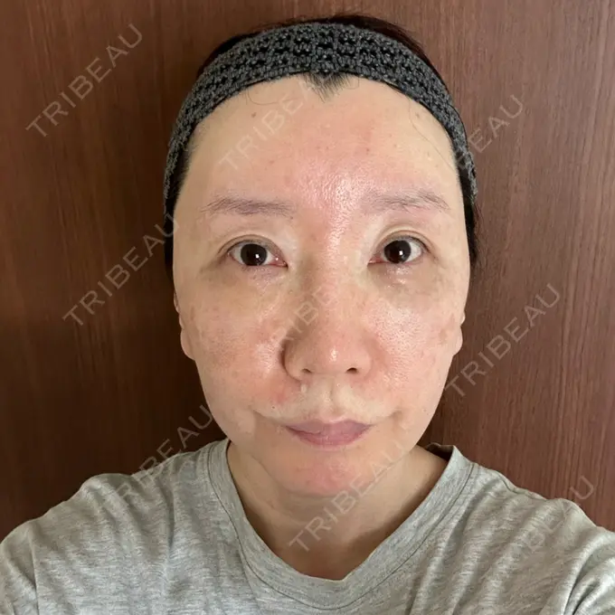 クマ治療 / 下まぶたたるみ取り / 脂肪注入（額） / 脂肪注入（目の下） / 脂肪注入（輪郭） エースクリニック 名古屋院 DAY 14 メイン用