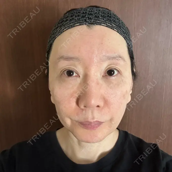 クマ治療 / 下まぶたたるみ取り / 脂肪注入（額） / 脂肪注入（目の下） / 脂肪注入（輪郭） エースクリニック 名古屋院 AFTER メイン用