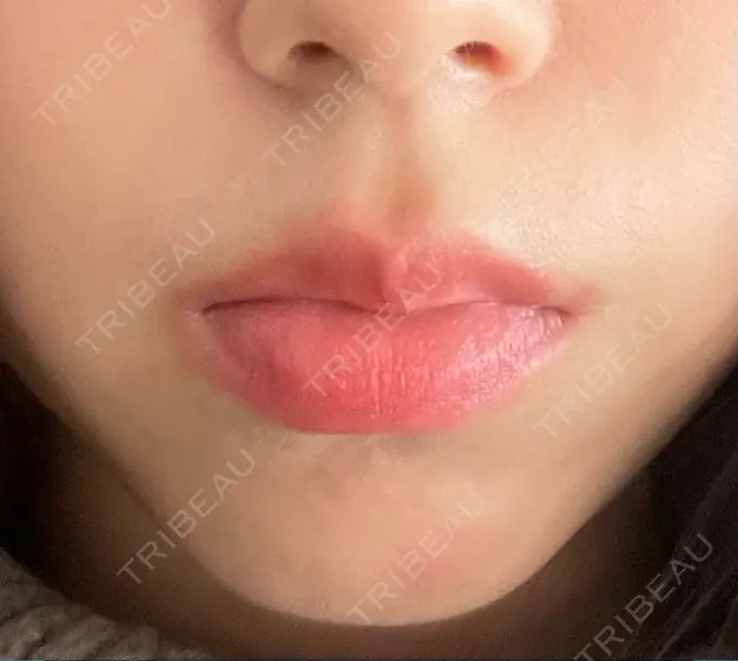 ボトックス（口角） / ボトックス（人中） veary clinic AFTER メイン用