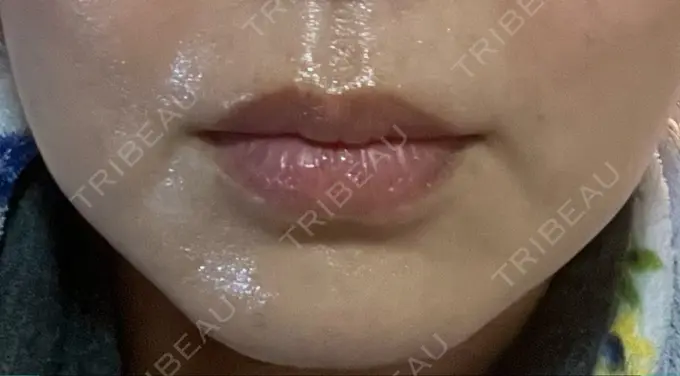 肌ヒアルロン酸注入（たるみ・シワ改善） / シワ取りボトックス TCB東京中央美容外科 福岡博多院 DAY 6 メイン用