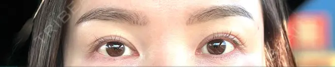 二重埋没 東京シンデレラ美容外科 大宮院 DAY 31 メイン用