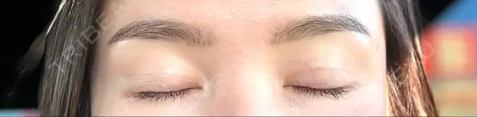 二重埋没 東京シンデレラ美容外科 大宮院 DAY 31 メイン用