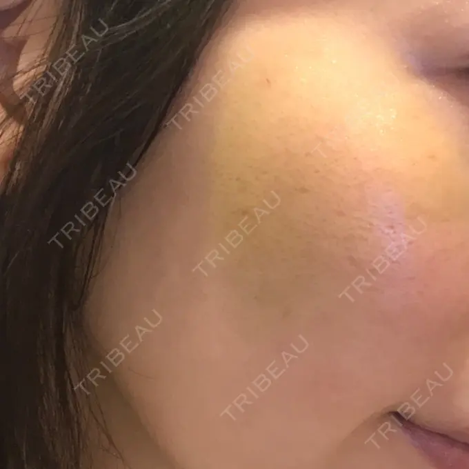 水光注射（ハリ・美肌） / 脂肪溶解注射（顔） / ハイフ（顔） チョンダムジュエンクリニック DAY 9 メイン用