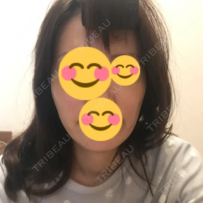 水光注射（ハリ・美肌） / 脂肪溶解注射（顔） / ハイフ（顔） チョンダムジュエンクリニック DAY 9 メイン用