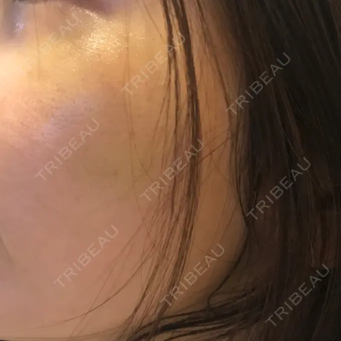 水光注射（ハリ・美肌） / 脂肪溶解注射（顔） / ハイフ（顔） チョンダムジュエンクリニック DAY 9 メイン用