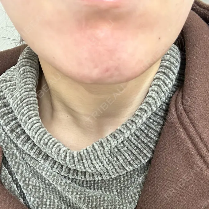 ボトックス（あご） TCB東京中央美容外科 高田馬場院 AFTER メイン用