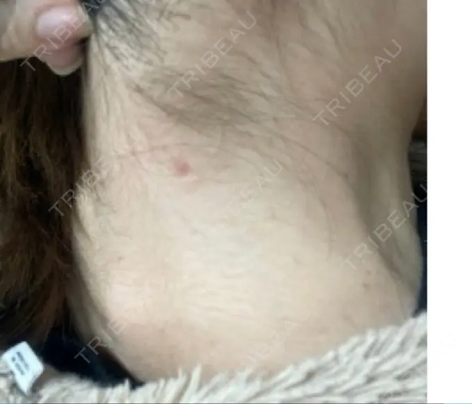 ほくろ・いぼ除去レーザー（肌） 美容皮膚科エルムクリニック 岡山院 DAY 21 メイン用