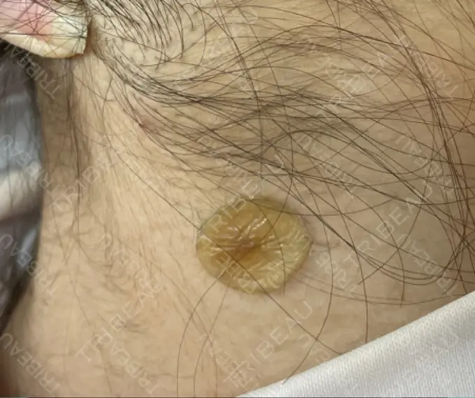 ほくろ・いぼ除去レーザー（肌） 美容皮膚科エルムクリニック 岡山院 DAY 8 メイン用