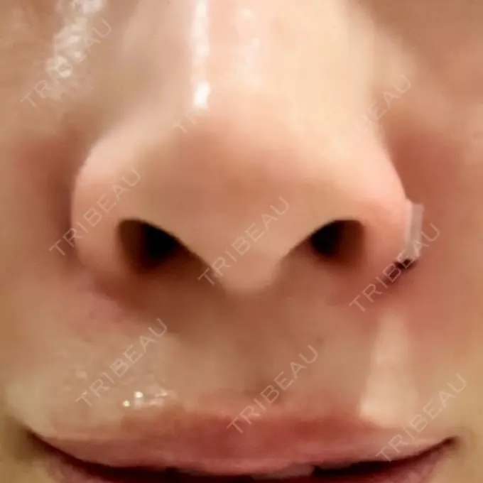 小鼻縮小（非切開） TCB東京中央美容外科 世田谷院 DAY 0 メイン用