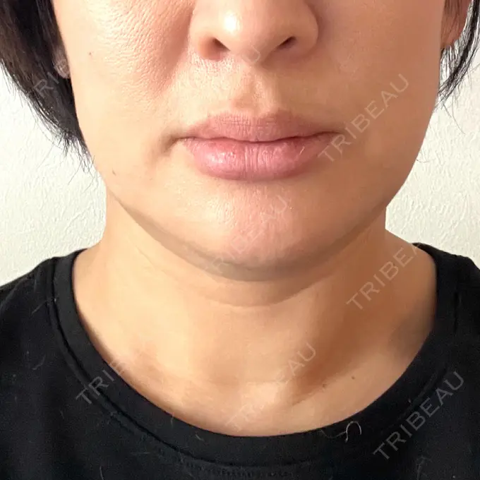 脂肪溶解注射（顔） 表参道ウィズ・クリニック DAY 0 メイン用