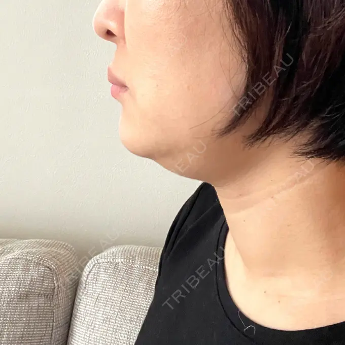 脂肪溶解注射（顔） 表参道ウィズ・クリニック DAY 0 メイン用