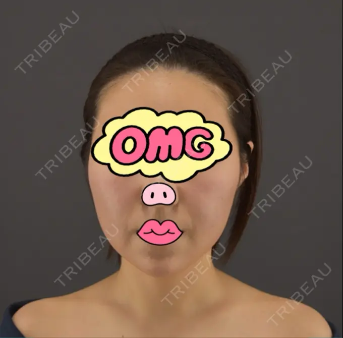 糸リフト / ボトックス（あご） / ヒアルロン酸注入（あご） / ボトックス（エラ・小顔） / ボトックス（口角） / ヒアルロン酸注入（頬） GRACIA clinic 【グラシアクリニック】 AFTER メイン用