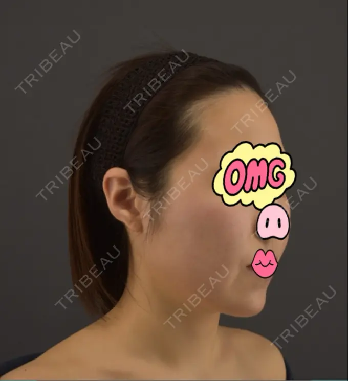 糸リフト / ボトックス（あご） / ヒアルロン酸注入（あご） / ボトックス（エラ・小顔） / ボトックス（口角） / ヒアルロン酸注入（頬） GRACIA clinic 【グラシアクリニック】 DAY 30 メイン用