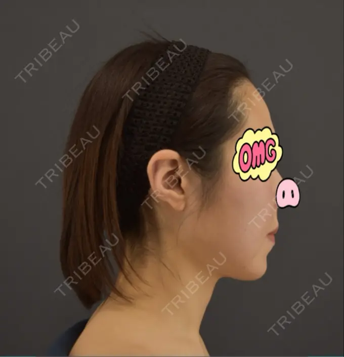 糸リフト / ボトックス（あご） / ヒアルロン酸注入（あご） / ボトックス（エラ・小顔） / ボトックス（口角） / ヒアルロン酸注入（頬） GRACIA clinic 【グラシアクリニック】 DAY 30 メイン用