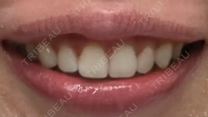 ボトックス（ガミースマイル） 椿クリニック 心斎橋院 AFTER メイン用